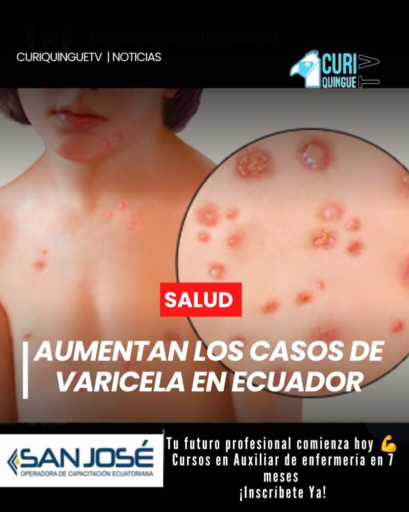 El Ministerio de Salud Pública mantiene una alerta sanitaria tras el incremento de casos de varicela en el país. En lo que va de 2026 se han registrado más de 4.000 contagios, una cifra superior a la reportada durante el mismo período del año anterior.