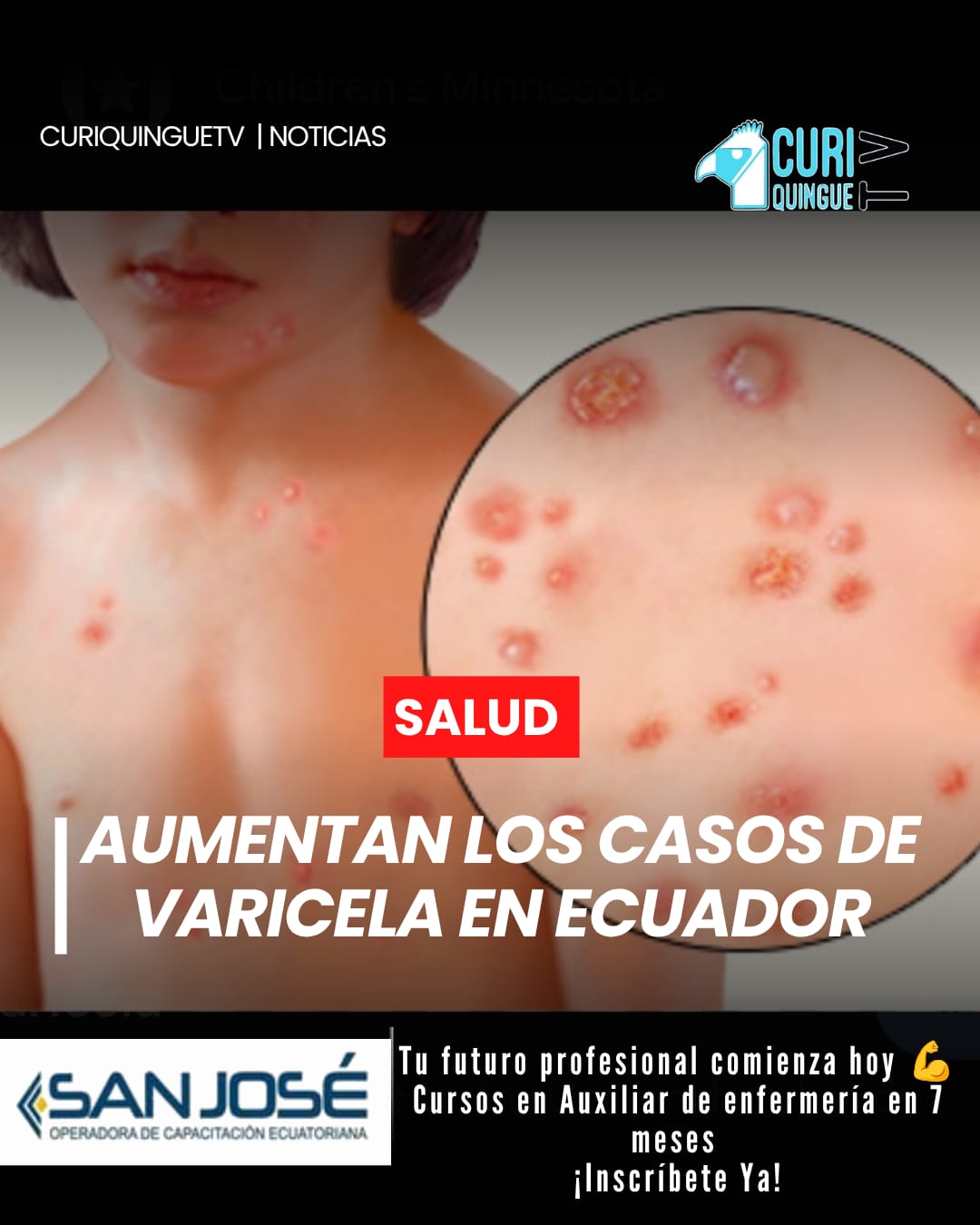 El Ministerio de Salud Pública mantiene una alerta sanitaria tras el incremento de casos de varicela en el país. En lo que va de 2026 se han registrado más de 4.000 contagios, una cifra superior a la reportada durante el mismo período del año anterior.